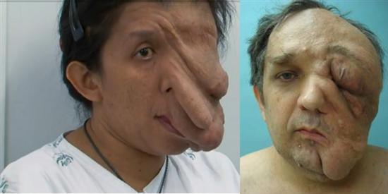 giant-facial-tumor
