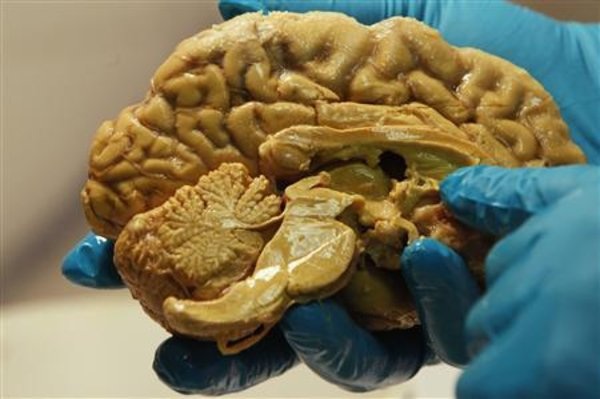 autopsy-confirms-n-h-patient-died-of-rare-brain-disease