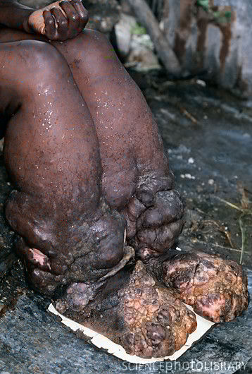 Elephantiasis